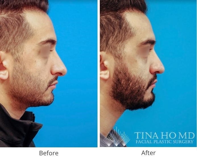 rhinoplasty surgery near me