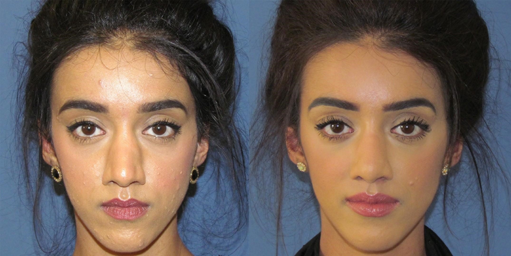 best rhinoplasty surgeons