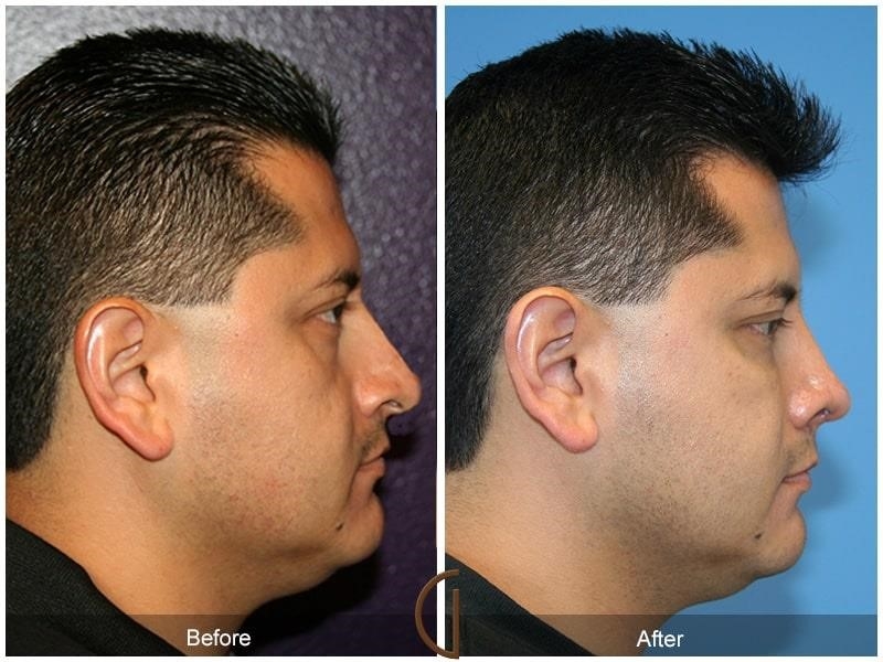 best rhinoplasty surgeons