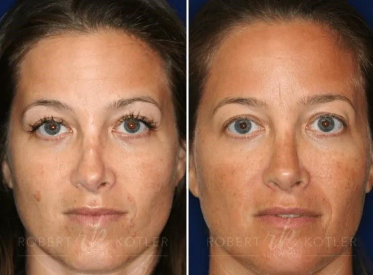 rhinoplasty surgery near me