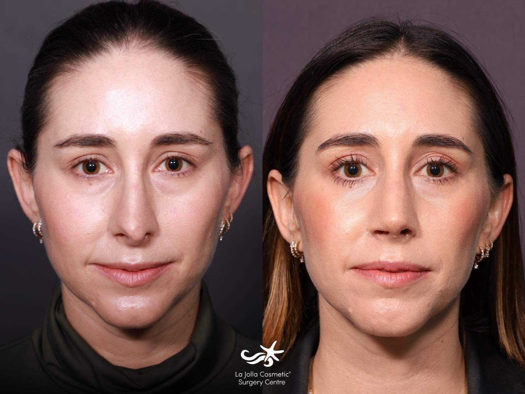 rhinoplasty surgery near me