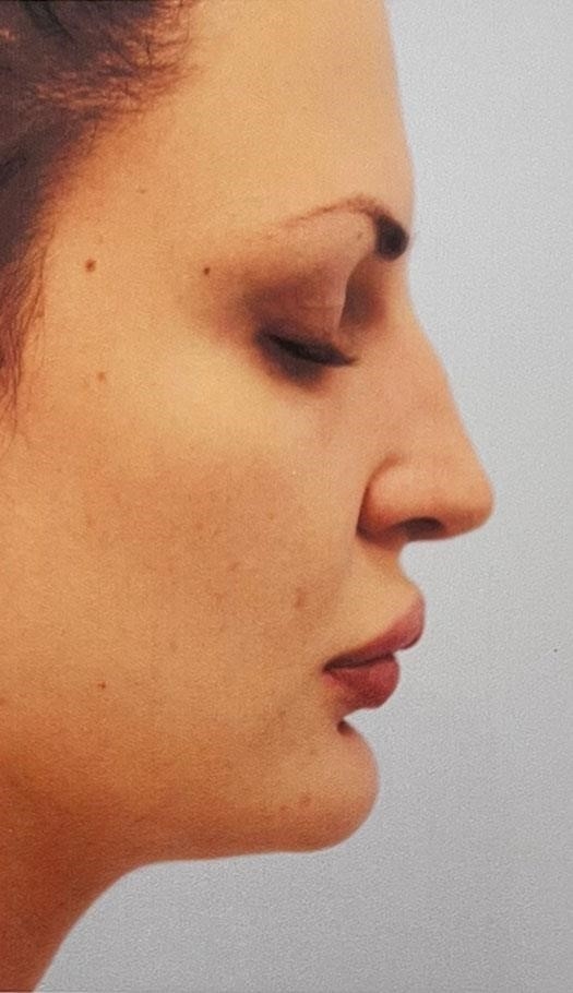 best rhinoplasty surgeons